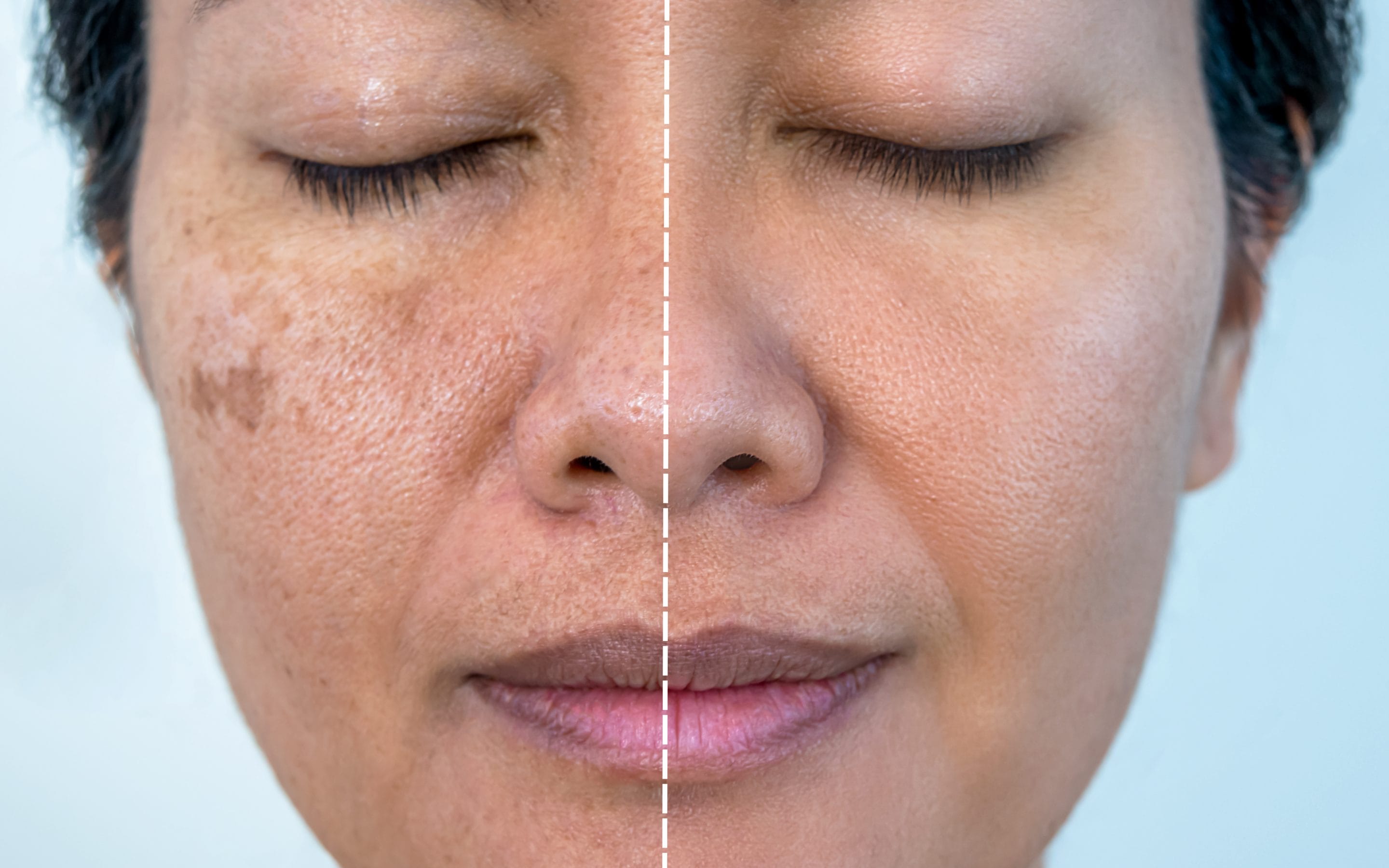 Hyperpigmentation: Navigating Through the Sea of Serums for Luminous Skin